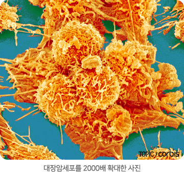 대장암세포를 2000배 확대한 사진