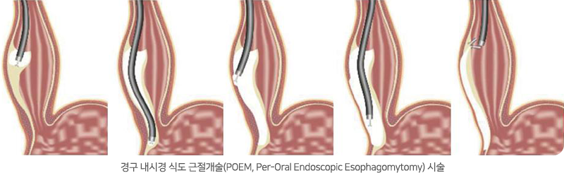 경구 내시경 식도 근절개술(POEM, Per-Oral Endoscopic Esophagomytomy) 시술