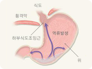 역류성식도염 증상