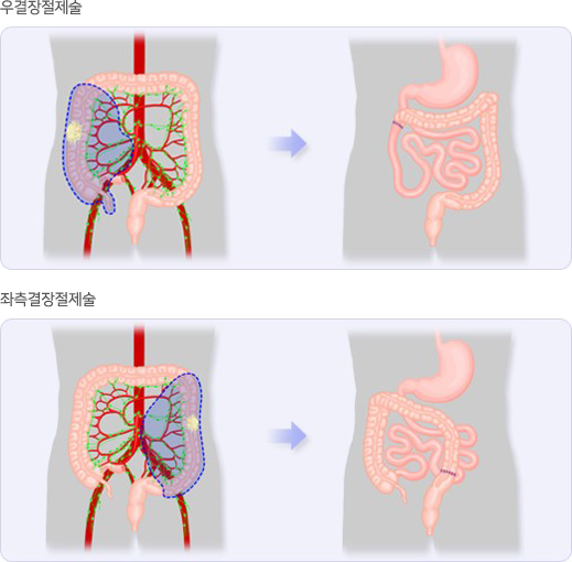 수술 요법 : 우결장절제술, 좌측결장절제술