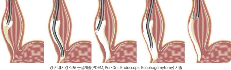 경구내시경식도근절개(POEM)