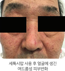 세툭시맙 사용 후 얼굴에 생긴 여드름성 피부변화